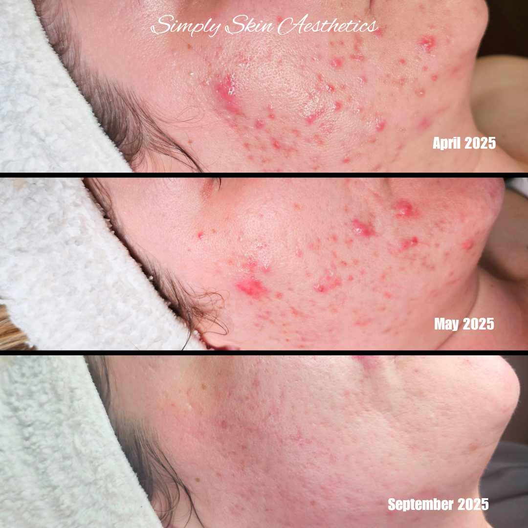 Simply Skin Aesthetics in New London, WI (2)