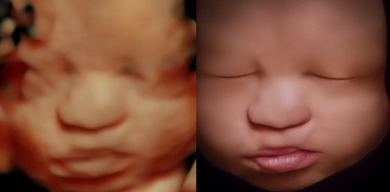 A Little Insight 3D 4D 5D Ultrasound in Vacaville, CA (3)
