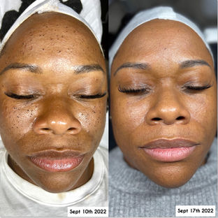 Belle Choses Skin in Hazlet, NJ (4)